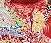 Prostate cancer with infiltration into bladder, lymph nodes, and urethra.