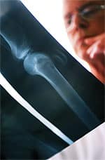 Osteoporosis and Vitamin K2 Intervention—the Evidence