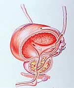 Benign Prostate Enlargement Endangers Men’s Health