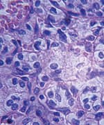 Microscopic image of kidney carcinoma.