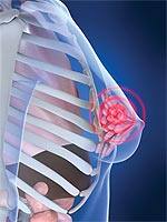 Tailoring Cancer Treatment for the Individual