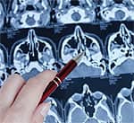 Inherited Abnormalities in Brain Chemistry