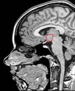 Traumatic Brain Injury and Hormones