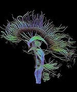 Hope for Traumatic Brain Injury Patients at Millennium Health Centers