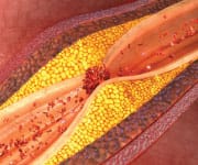 How Arterial Stiffness Accelerates Aging