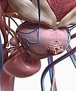 Treating Human Prostate Cancer in Mice