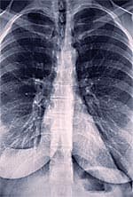 Inhaled Insulin Increases Lung Cancer Risk