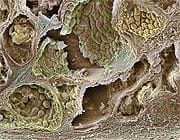 Prostate cancer. Scanning electron micrograph