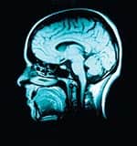 B Vitamin Supplements Slow Brain Atrophy in Cognitively Impaired Patients