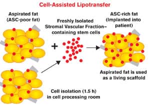Cell-Assisted Lipotransfer