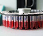 Consequences of Post-meal Glucose Surge