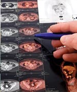 Role of Functional PET Scans in Cancer Care