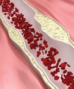 Coronary atherosclerosis desease