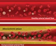 Atherosclerotic plaque