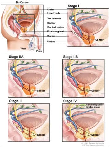 Five Stages of Prostate Cancer Progression