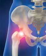 Anti-Arthritis Vaccine