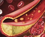 Factors Of Reduced Endothelium-Dependent Dilation