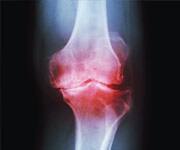 Omega-3 Supplements Ease Osteoarthritis Pain In Mice