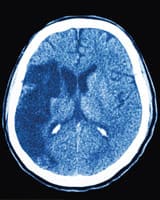 Acting F.A.S.T. Is Key For Stroke