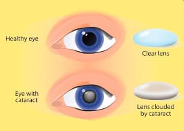 Understanding Cataracts