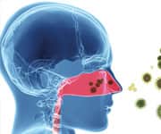 What Is Sinusitis?