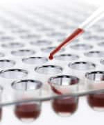 High LDL Levels in Early Life Predict Coronary Calcification