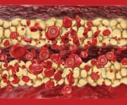 Higher Serum Magnesium Levels Linked with Decreased Artery Calcification