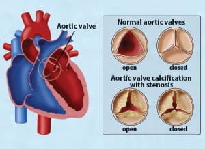 Aortic Valve Calcification and Aortic Stenosis