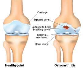 Osteoarthritis
