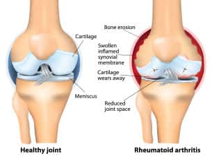 Rheumatoid Arthritis