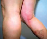 Symptoms of Deep Vein Thrombosis