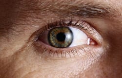 High homocysteine, low folate and B12 predict macular degeneration