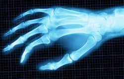 Vitamin B6 supplementation lowers inflammation in rheumatoid arthritis patients