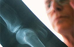 Deficient vitamin D levels result in early aging of bone