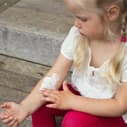 Vitamin D supplementation helpful for childhood atopic dermatitis