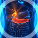 Pancreatic cancer may be linked to insufficient vitamin D