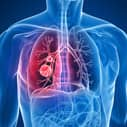 Meta-analysis concludes protective association for high vitamin D against lung cancer