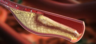 Unstable atherosclerotic plaque similar to cancer