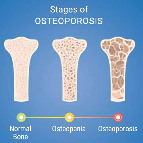 Stages of Osteoporosis