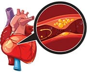 Myocardial Infarction
