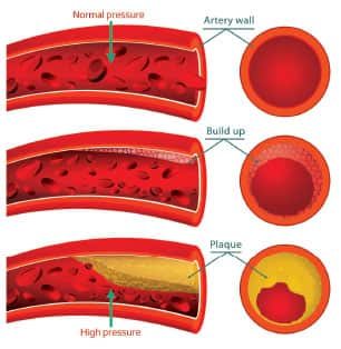 Arterial Plaque Rupture | Life Extension Magazine