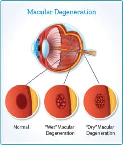 chart comparing a normal macula to one undergoing degeneration