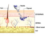 Diagram of skin layers and tattoo ink