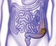 Purple intestine supported by cistanche