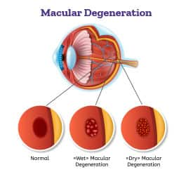 Infographic of macular degeneration and signs