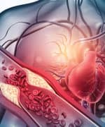 Artery and heart experiencing plaque buildup from atherosclerosis