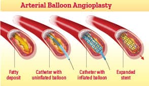 Infographic of arterial balloon angioplasty within arteries