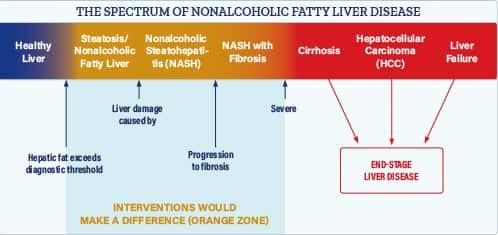 'The Spectrum of Nonalcholic Fatty Liver Disease' infographic