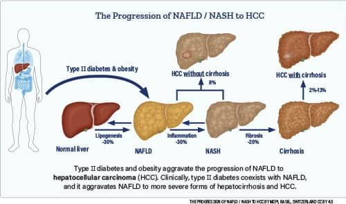 'The Progression of NAFLD/NASH to HCC' infographic