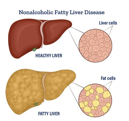 'Nonalcoholic Fatty Liver Disease'  infographic of the difference between livers